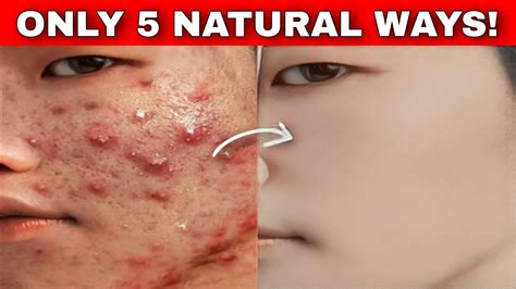 Paano Mawala ang Pimples: Helpful Tips to Fight Acne.